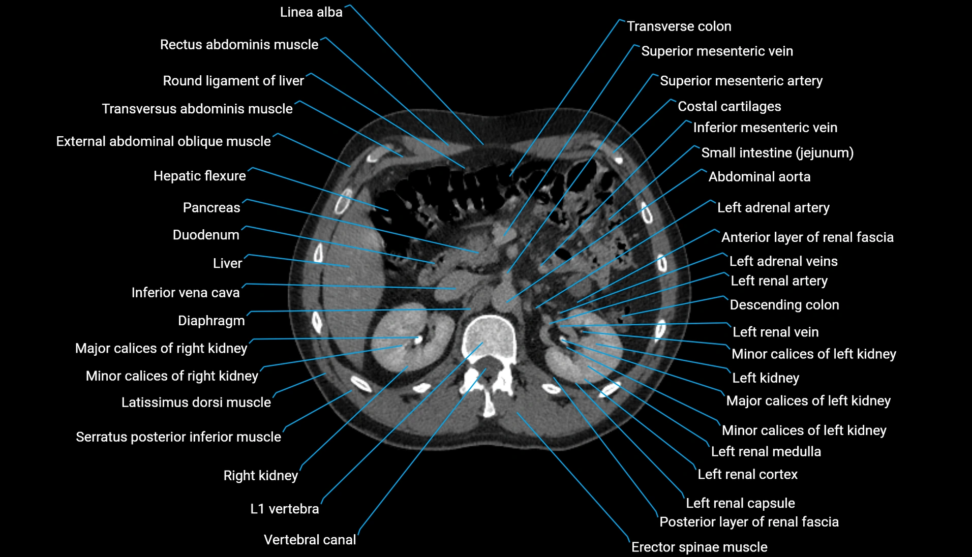 CT urogram axial cross sectional anatomy  labelled radiology image-00093.webp